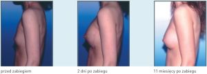 Zdjęcia po zabiegu 3