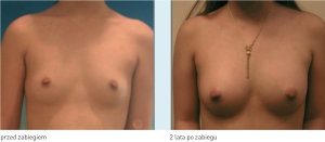 Zdjęcia po zabiegu 5